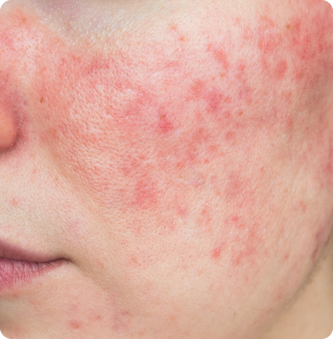 Professional, Proven, and Personalised Rosacea Treatment