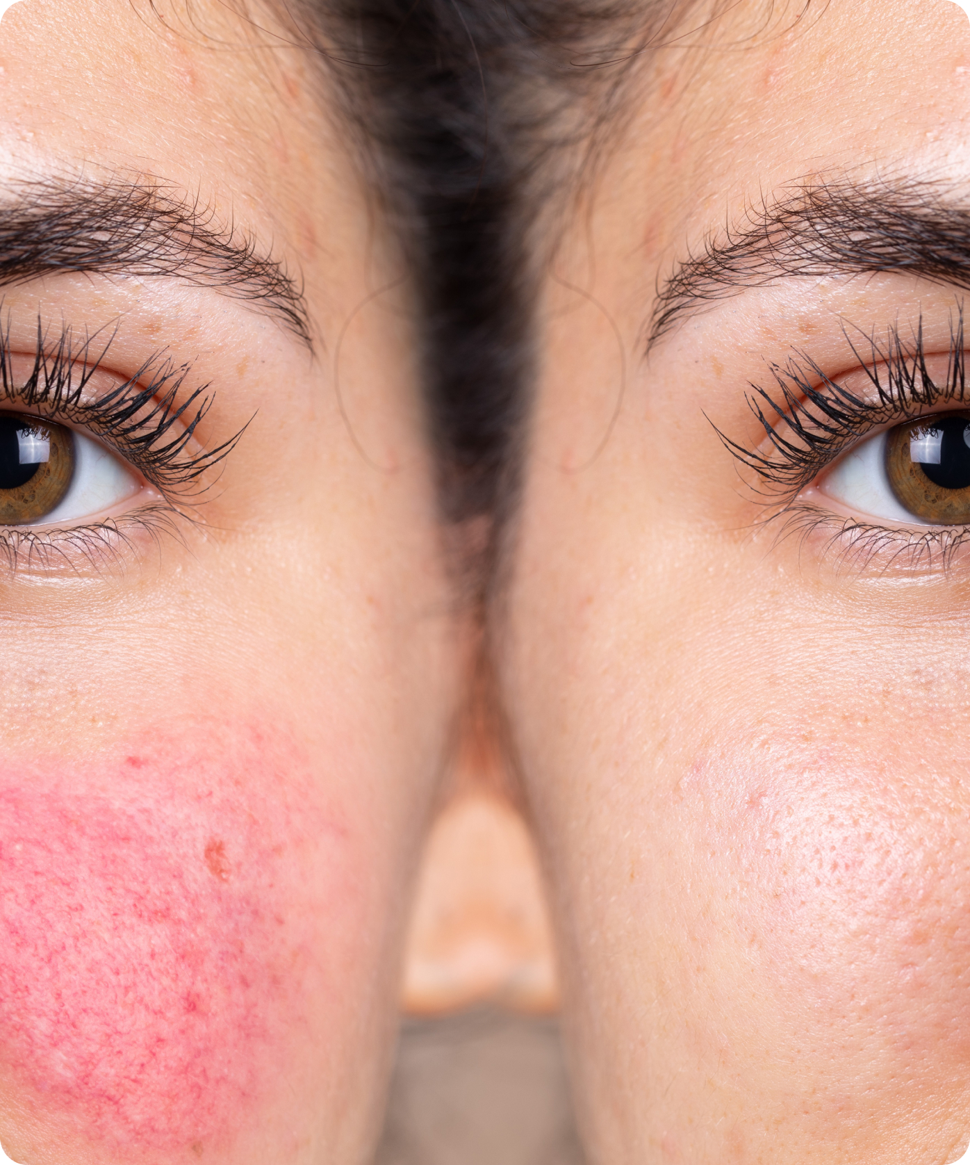 Professional, Proven, and Personalised Rosacea Treatment