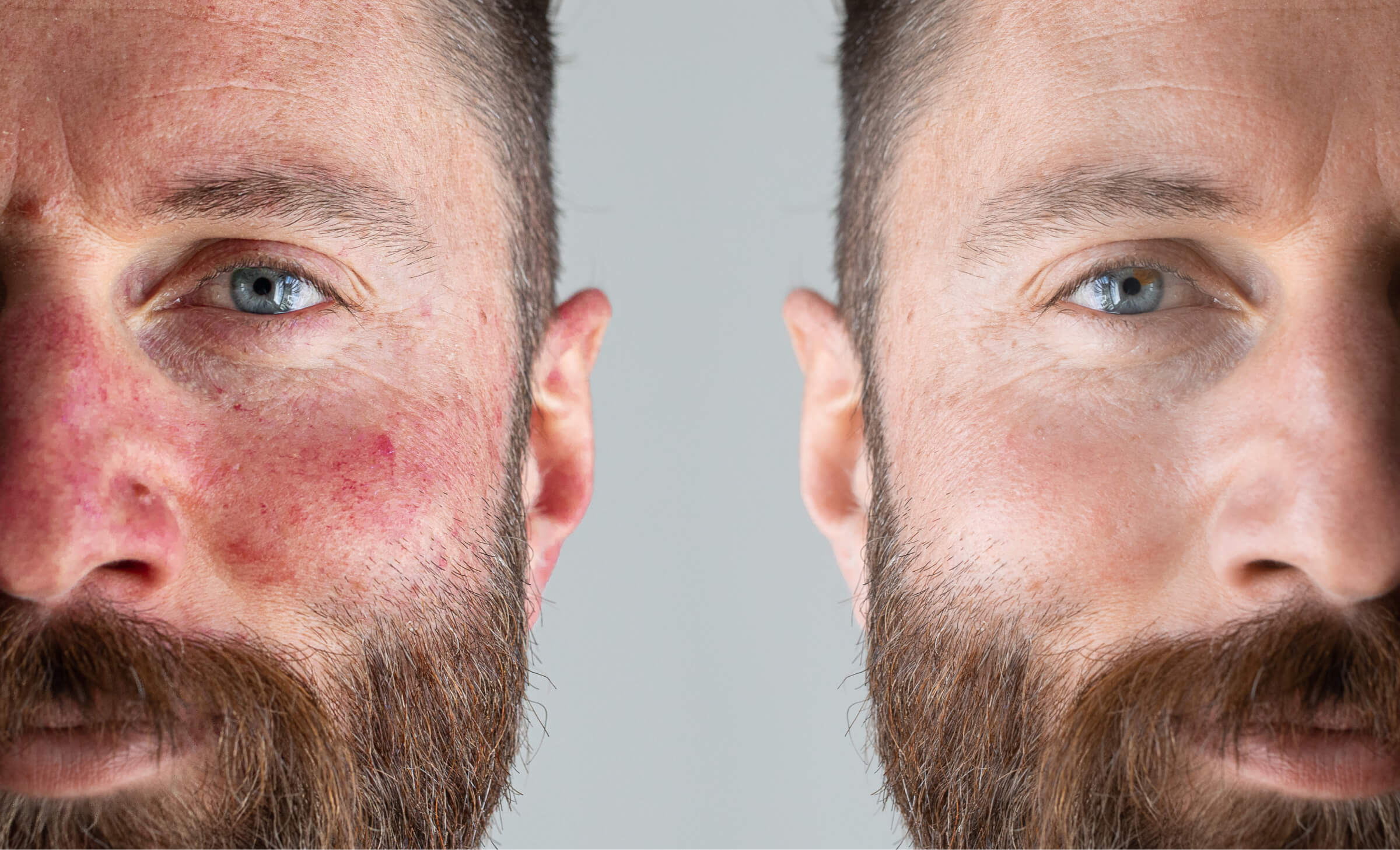 The Rosacea Clinic Canberra